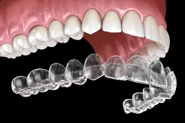 Ideal Candidate Traits For Invisalign Therapy